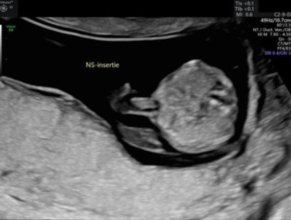 Abdomen. Beoordeling buikwand en navelstrenginsertie ter hoogte van foetale abdomen. Transversale doorsnede. Beeld 2.
